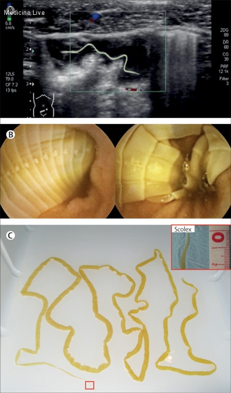 Интересный случай: Раннее сканирование выявляет червя: УЗИ брюшной полости как возможный метод скрининга кишечных цестод