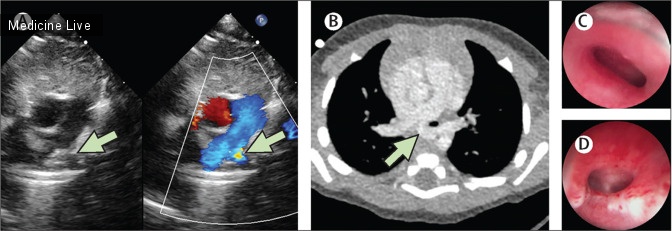 Интересный случай: Шумное дыхание у 2-месячного ребенка: слинг легочной артерии