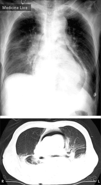 Интересный случай: Пневмоперикард после разрыва пищевода