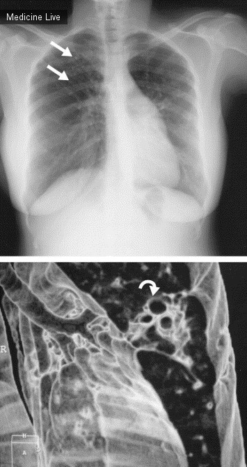 Интересный случай: Кистозные бронхоэктазы