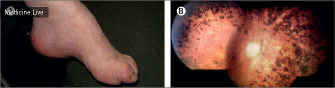 Интересный случай: Пигментный ретинит и полая стопа при PHARC — полинейропатия, потеря слуха, атаксия, пигментный ретинит и катаракта — синдром у 62-летнего мужчины