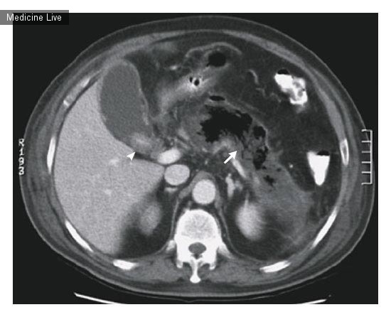 Интересный случай: Эмфизематозный панкреатит