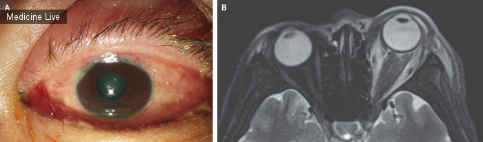 Интересный случай: Ишемическая ретинопатия вследствие длительного сдавления орбиты