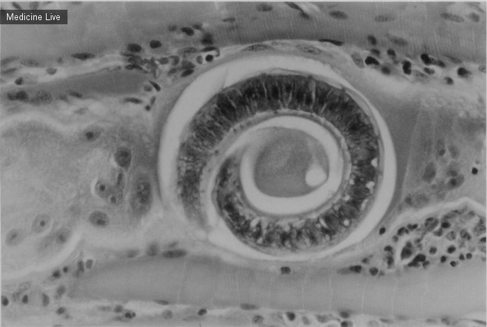 Интересный случай: Свернутая личинка Trichinella spiralis