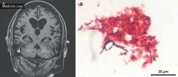 Интересный случай: Нокардиальный абсцесс мозга