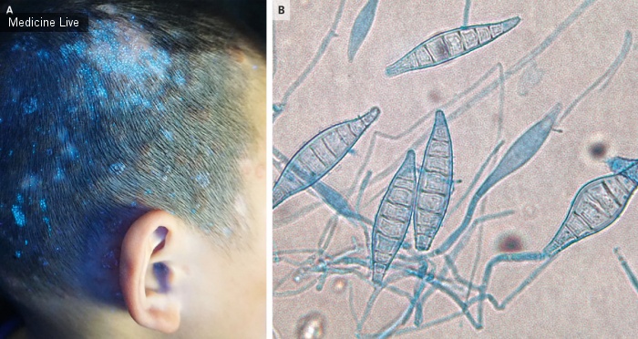 Интересный случай: Опоясывающий лишай, вызванный Microsporum canis
