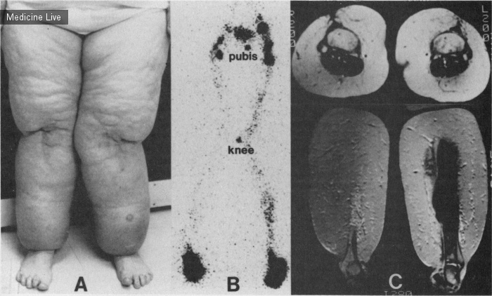 Интересный случай: Массивное ожирение, симулирующее лимфедему